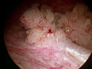 bladder tumor