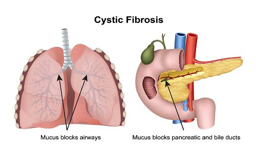 Cystic Fibrosis و نکاتی مهم پیرامون آن