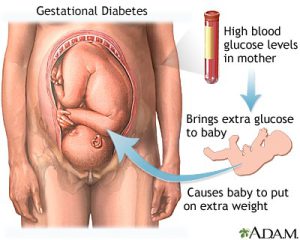 دیابت حاملگی