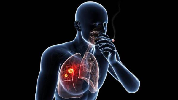 درمان سرطان ریه افراد غیر سیگاری با دارو