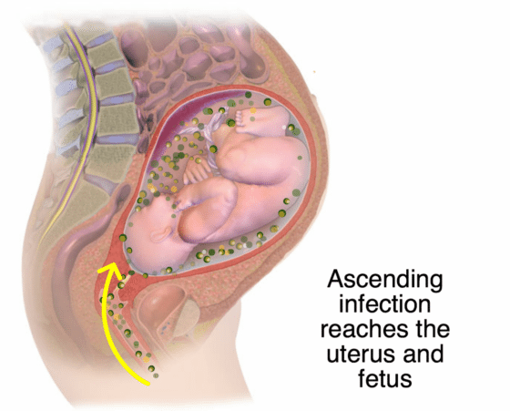 تصویر نشان‌دهنده این است که عفونت در دوران بارداری به رحم و جنین می‌رسد.