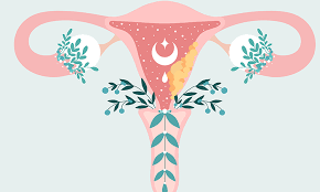 سرطان تخمدان ، تصویر ایلاستوریتوری دستگاه تناسلی زنان