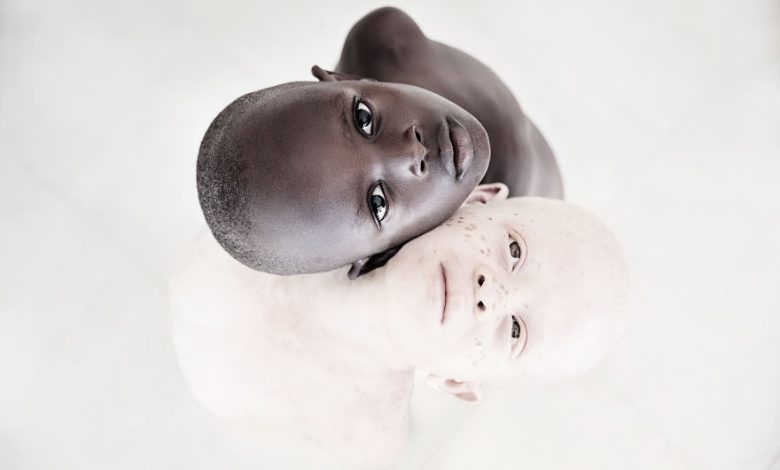 بیماری آلبینیسم (Albinism)