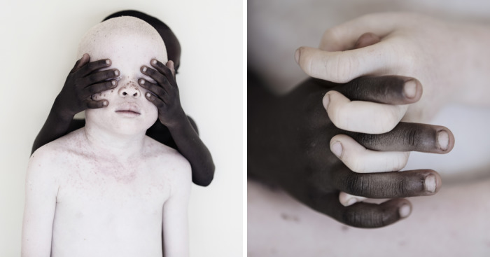 کودکان مبتلا به آلبینیسم (Albinism) یا زالی در کنار کودکان رنگین پوست