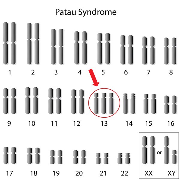 سندرم پاتو (Patau syndrome) حضور یک کروموزوم اضافی ۱۳ در سلول است.(تریزومی۱۳)