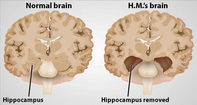 اختلالات عملکردی هیپوکمپ مغز