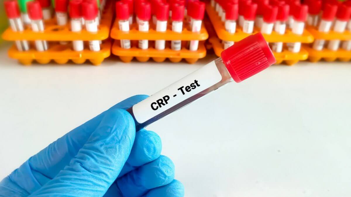 آزمایش خون(CRP)