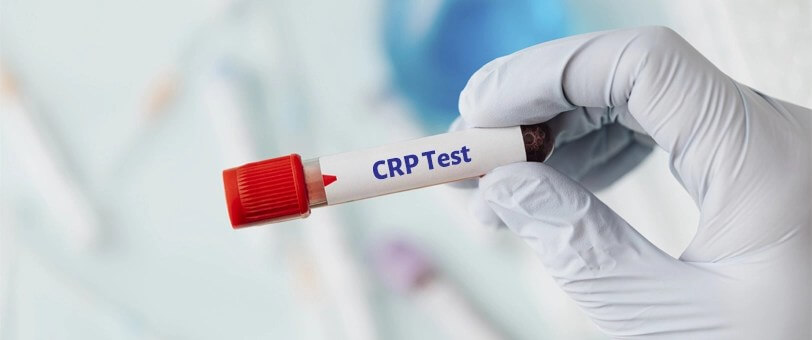 آزمایش C-REACTIVE PROTEIN یا CRP