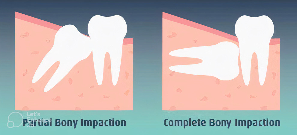 دندان عقل ، نهفتگی استخوانی کامل و نهفتگی جزئی استخوانی