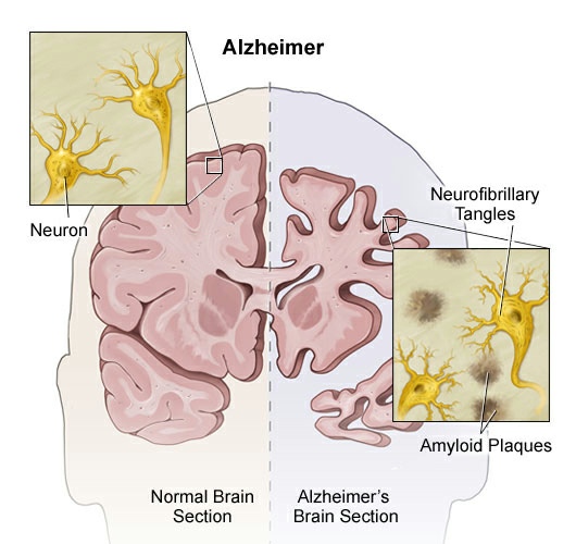 تجمع آمیلوئید در مغز افراد مبتلا به آلزایمر