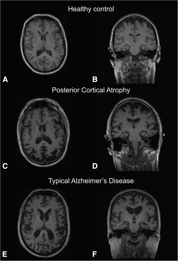 مغز افراد مبتلا به الزایمر