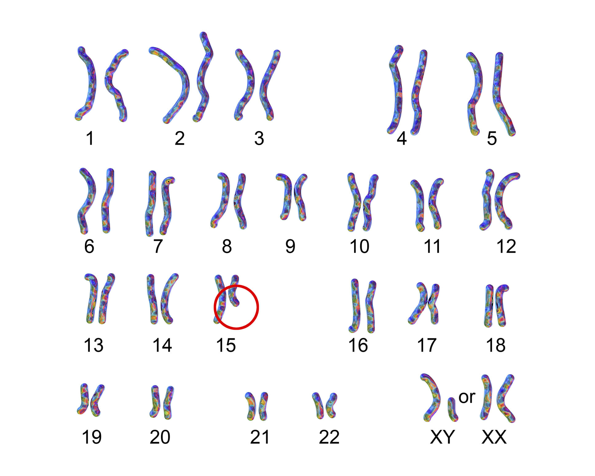 سندرم پرادرویلی به‌دلیل از دست‌رفتن بخشی از اطلاعات ژنتیکی در کروموزوم 15 اتفاق می‌افتد.